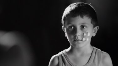 a little boy with bandages on his face